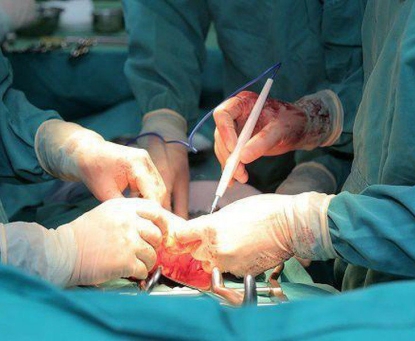 Tại Sao Thoát Vị Đùi Hay Bị Nghẹt Hơn So Với Thoát Vị Bẹn?